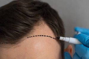 Hands of specialist in rubber gloves make marks on forehead of man on grey background. Male patient prepares for hair transplant surgery closeup