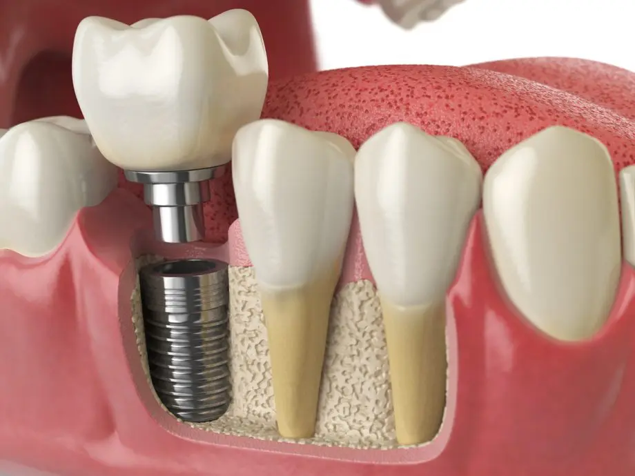 Teeth Implants