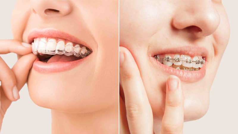 aligners braces