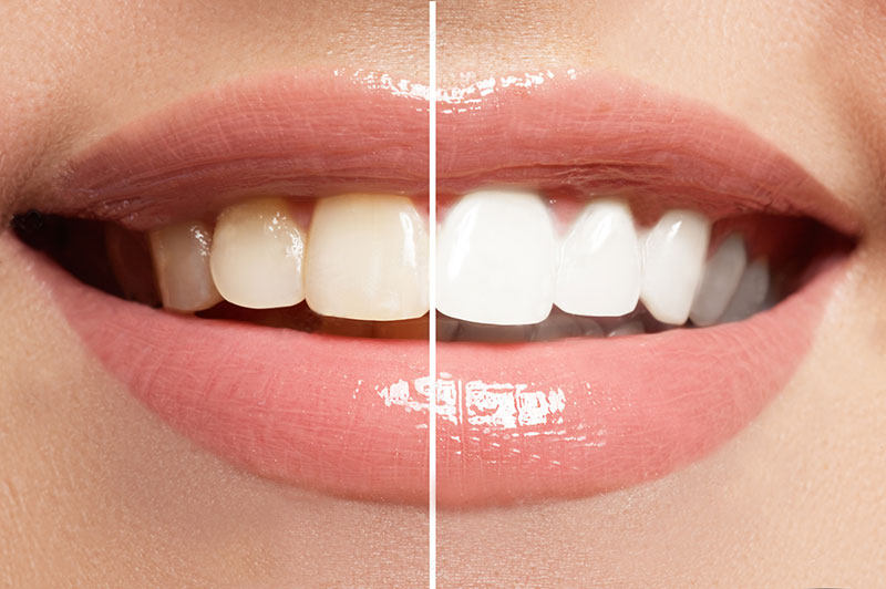 teeth whitening in abu dhabi